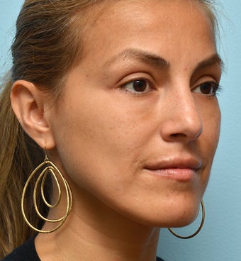 Eye Dermafillers, Cheek Dermafillers, Facial Dermafillers 454584