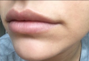 18-24 year old woman treated with Lip Augmentation after 2847439