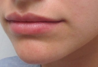 18-24 year old woman treated with Lip Augmentation before 2847439