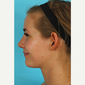 25-34 year old woman treated with Rhinoplasty after 3629421