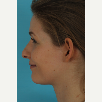 25-34 year old woman treated with Rhinoplasty before 3629421
