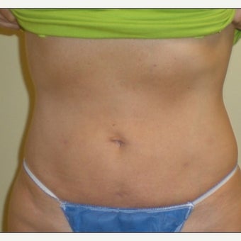 55-64 year old woman treated with Laser Liposuction Revision after 2039806