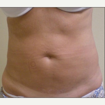 55-64 year old woman treated with Laser Liposuction Revision before 2039806