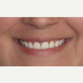 29 year old woman treated with Juvederm injections in the lips before 3837270