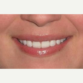 29 year old woman treated with Juvederm injections in the lips after 3837270