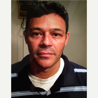 35-44 year old man treated with Ptosis Surgery after 3726505
