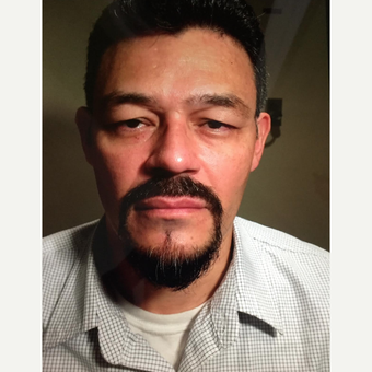 35-44 year old man treated with Ptosis Surgery before 3726505