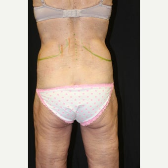 55-64 year old woman treated with CoolSculpting before 1579612