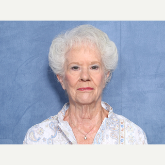 75 and up year old woman treated with Neck Lift (view 1 of 2) before 3175799