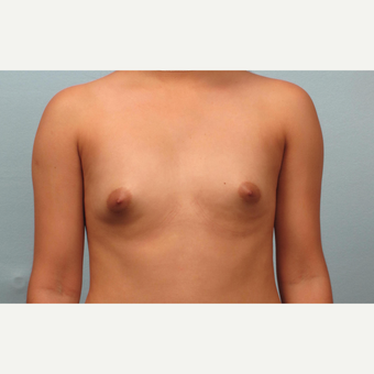 18-24 year old woman treated with Breast Augmentation before 3245288