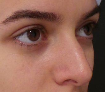 Non Surgical Nose Job before 3364429