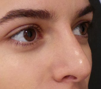 Non Surgical Nose Job after 3364429