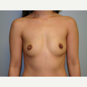 Breast Augmentation before 3560695