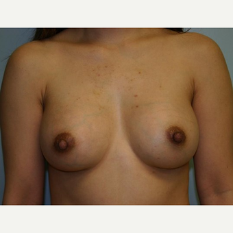Breast Augmentation after 3560695