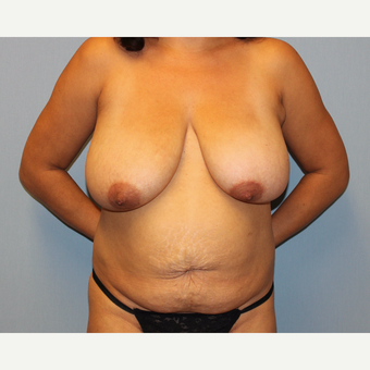 35-44 year old woman treated with Mommy Makeover before 3589429