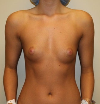 Moderate profile 300CC saline implants filled to 330CC before 1017476