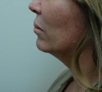 52 year old female for neck, 15 months before 1372262