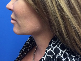52 year old female for neck, 15 months after 1372262