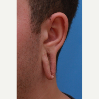 18-24 year old man after 2" Gauges before 3590465