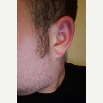 18-24 year old man after 2" Gauges after 3590465