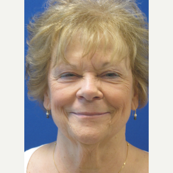 65-74 year old woman treated with Lower Face Lift before 3802702