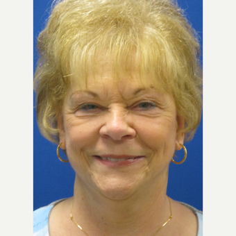 65-74 year old woman treated with Lower Face Lift after 3802702