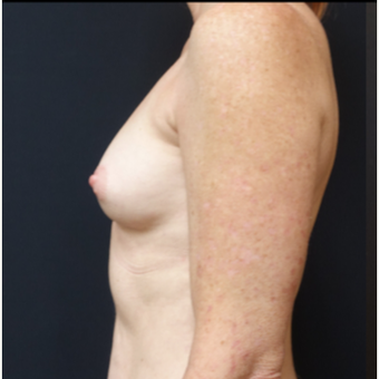 35-44 year old woman treated with Breast Implants before 3529808