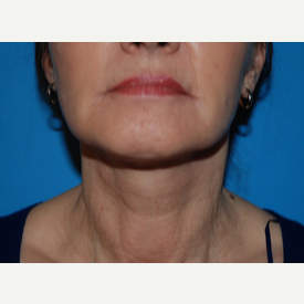55-64 year old woman treated with Facelift, Necklift after 3065351