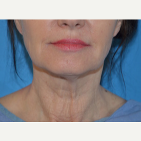 55-64 year old woman treated with Facelift, Necklift before 3065351