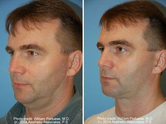 Neck Liposuction before 212297