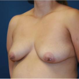 35-44 year old woman treated with Breast Lift with Implants before 3554347