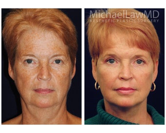 Full Facial Rejuvenation: Necklift before 1196648