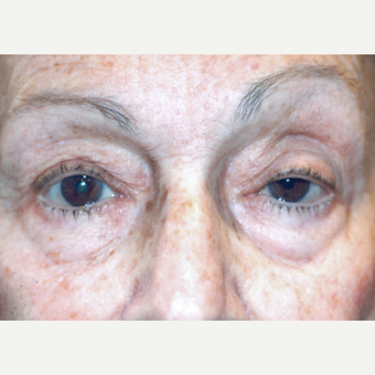 75 and up year old woman treated with Ptosis Surgery before 3085549