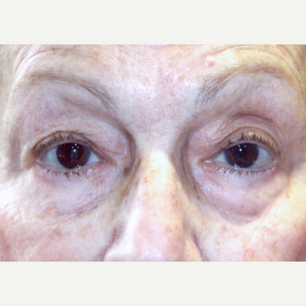 75 and up year old woman treated with Ptosis Surgery after 3085549