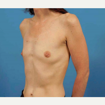 35-44 year old woman treated with Breast Implants before 3787013