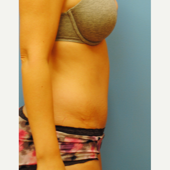 45-54 year old woman treated with Tummy Tuck after 3070841