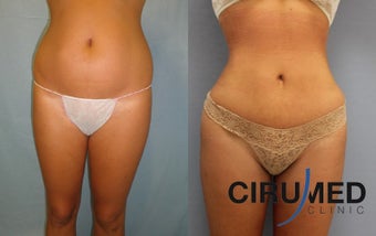 Brazilian butt lift with Water Jetstream Liposculpture after 1104280