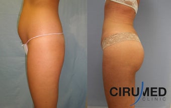 Brazilian butt lift with Water Jetstream Liposculpture 1104280