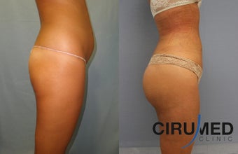 Brazilian butt lift with Water Jetstream Liposculpture 1104280