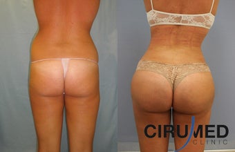 Brazilian butt lift with Water Jetstream Liposculpture before 1104280