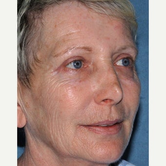 63 year old woman treated with Fraxel Repair, CO2 and Erbium before 2078676
