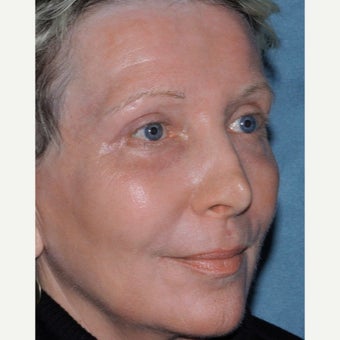 63 year old woman treated with Fraxel Repair, CO2 and Erbium after 2078676