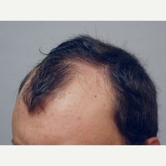 Hair Transplant before 3241306