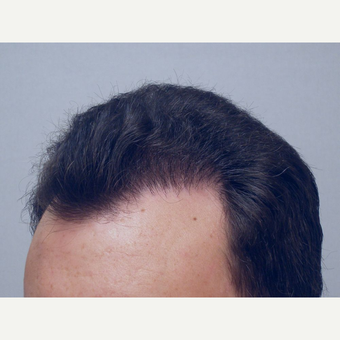 Hair Transplant after 3241306