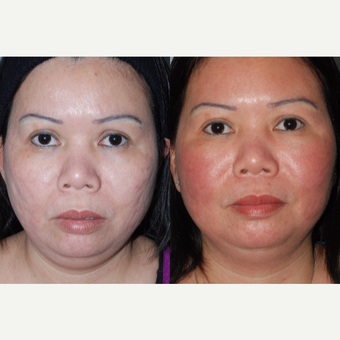 25-34 year old woman treated with Acne Scars Treatment before 2744395
