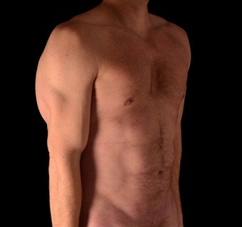 35-44 year old man treated with Tumescent Liposuction after 1864378