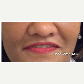 45-54 year old woman treated with Juvederm for Lip Augmentation before 3059000