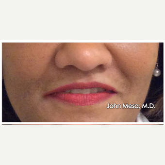 45-54 year old woman treated with Juvederm for Lip Augmentation after 3059000