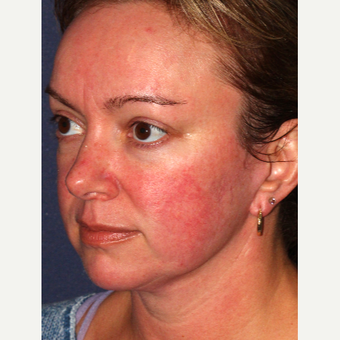 35-44 year old woman treated with IPL before 3346049