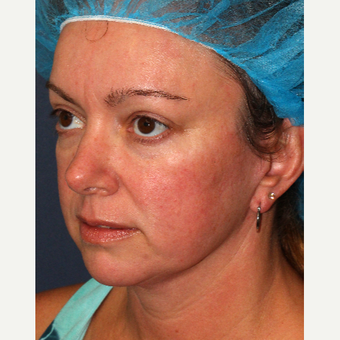 35-44 year old woman treated with IPL after 3346049